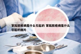 掌跖膿皰病是什么引起的 掌跖膿皰病是什么引起的圖片