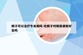 蝎子可以治療牛皮癬嗎 吃蝎子對銀屑病有好處嗎