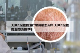 天津長征醫(yī)院治療銀屑病怎么樣 天津長征醫(yī)院治皮膚病好嗎