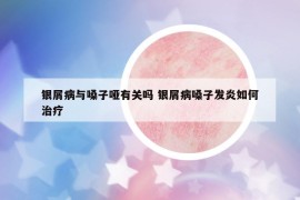 銀屑病與嗓子啞有關(guān)嗎 銀屑病嗓子發(fā)炎如何治療