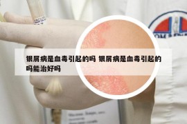 銀屑病是血毒引起的嗎 銀屑病是血毒引起的嗎能治好嗎