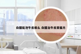 白醋能泡牛皮癬么 白醋治牛皮屑偏方