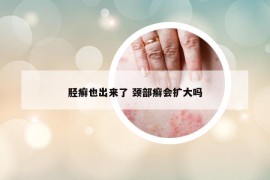 脛癬也出來了 頸部癬會擴大嗎