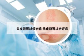 頭皮蘚可以根治嘛 頭皮蘚可以治好嗎