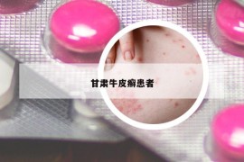 甘肅牛皮癬患者