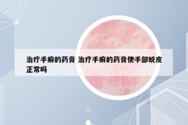 治療手癬的藥膏 治療手癬的藥膏使手部蛻皮正常嗎