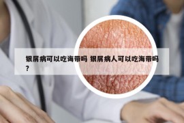 銀屑病可以吃誨帶嗎 銀屑病人可以吃海帶嗎?