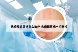 頭癬及銀屑病怎么治療 頭癬銀屑病一招斷根
