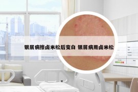 銀屑病擦鹵米松后變白 銀屑病用鹵米松