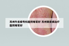蘇州牛皮癬?？漆t(yī)院哪家好 蘇州銀屑病治療醫(yī)院哪家好