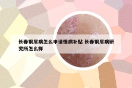長春銀屑病怎么申請慢病補(bǔ)貼 長春銀屑病研究所怎么樣