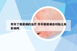 懷孕了銀屑病的治療 懷孕銀屑病會(huì)對(duì)胎兒有影響嗎