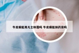 牛皮癬能用凡士林霜嗎 牛皮癬能抹藥膏嗎