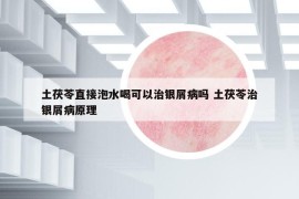 土茯苓直接泡水喝可以治銀屑病嗎 土茯苓治銀屑病原理