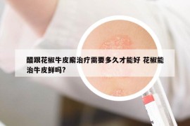 醋跟花椒牛皮廨治療需要多久才能好 花椒能治牛皮鮮嗎?