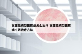 掌跖膿皰型銀屑病怎么治療 掌跖膿皰型銀屑病中藥治療方法