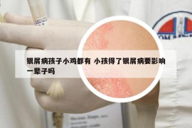 銀屑病孩子小雞都有 小孩得了銀屑病要影響一輩子嗎