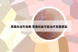 芙美松治牛皮癬 芙美松能不能治療真菌感染