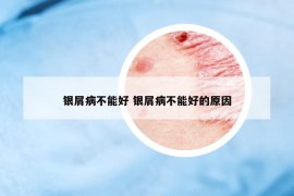 銀屑病不能好 銀屑病不能好的原因
