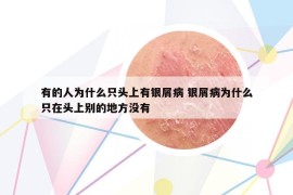 有的人為什么只頭上有銀屑病 銀屑病為什么只在頭上別的地方沒有