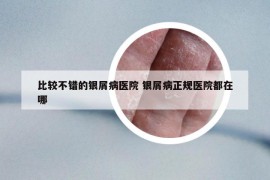 比較不錯的銀屑病醫(yī)院 銀屑病正規(guī)醫(yī)院都在哪