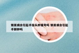 銀屑病會(huì)引起手指頭腫痛彎嗎 銀屑病會(huì)引起手腳腫嗎