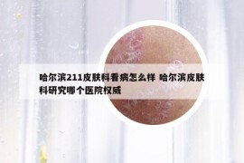 哈爾濱211皮膚科看病怎么樣 哈爾濱皮膚科研究哪個(gè)醫(yī)院權(quán)威