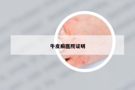 牛皮癬醫(yī)院證明