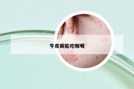 牛皮癬能吃咖喱