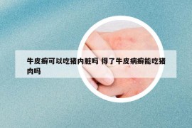 牛皮癬可以吃豬內(nèi)臟嗎 得了牛皮病癬能吃豬肉嗎