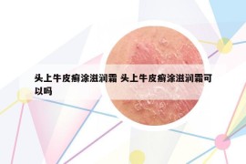 頭上牛皮癬涂滋潤(rùn)霜 頭上牛皮癬涂滋潤(rùn)霜可以嗎