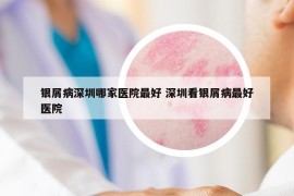 銀屑病深圳哪家醫(yī)院最好 深圳看銀屑病最好醫(yī)院