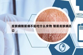 皮膚病銀屑病不能吃什么食物 銀屑皮膚病忌口