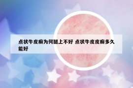 點狀牛皮癬為何腿上不好 點狀牛皮皮癬多久能好