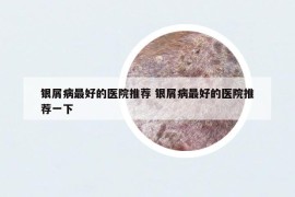 銀屑病最好的醫(yī)院推薦 銀屑病最好的醫(yī)院推薦一下