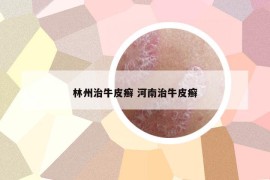 林州治牛皮癬 河南治牛皮癬