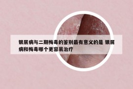 銀屑病與二期梅毒的鑒別最有意義的是 銀屑病和梅毒哪個(gè)更容易治療