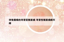 伴有瘙癢的尋常型銀屑病 尋常性銀屑病癢不癢
