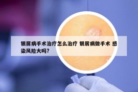 銀屑病手術(shù)治療怎么治療 銀屑病做手術(shù) 感染風(fēng)險大嗎?