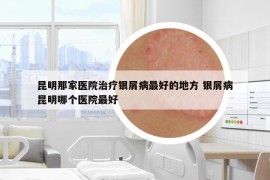 昆明那家醫(yī)院治療銀屑病最好的地方 銀屑病昆明哪個醫(yī)院最好