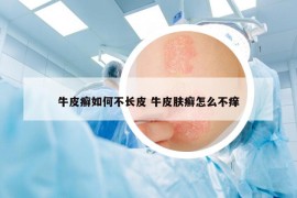 牛皮癬如何不長(zhǎng)皮 牛皮膚癬怎么不癢