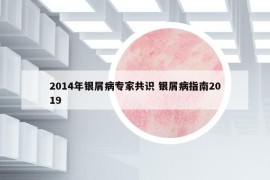 2014年銀屑病專家共識(shí) 銀屑病指南2019