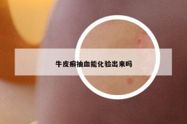 牛皮癬抽血能化驗出來嗎