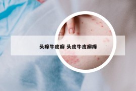 頭癢牛皮癬 頭皮牛皮癬癢