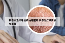 長春市治療牛皮癬的好醫(yī)院 長春治療銀屑病哪里好