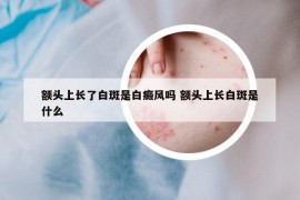額頭上長了白斑是白癜風(fēng)嗎 額頭上長白斑是什么