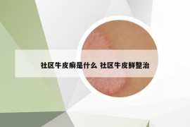 社區(qū)牛皮癬是什么 社區(qū)牛皮鮮整治