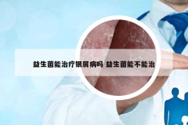 益生菌能治療銀屑病嗎 益生菌能不能治
