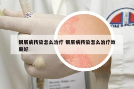 銀屑病傳染怎么治療 銀屑病傳染怎么治療效果好