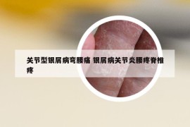 關(guān)節(jié)型銀屑病彎腰痛 銀屑病關(guān)節(jié)炎腰疼脊椎疼